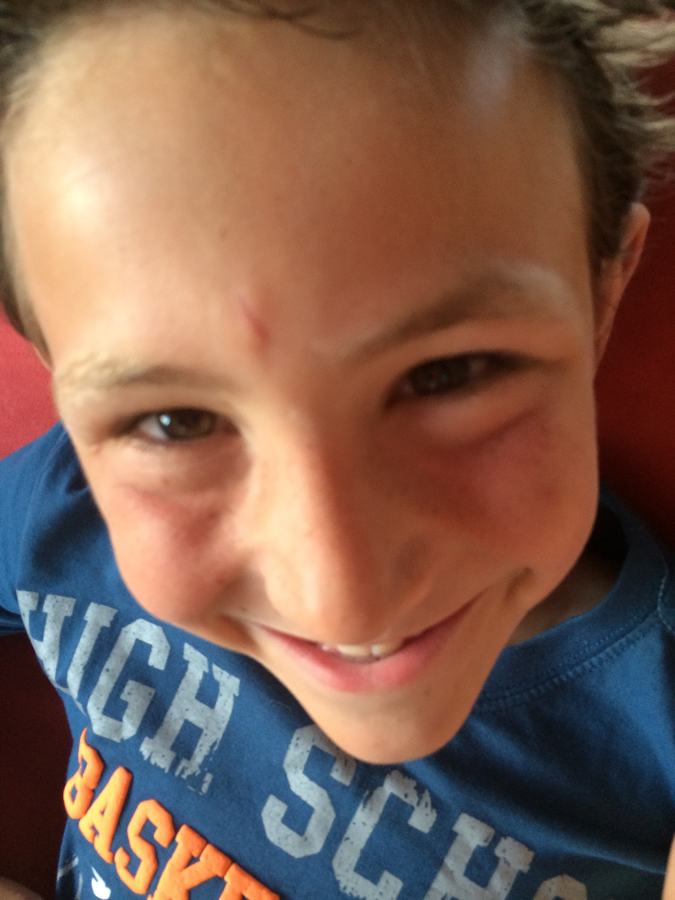 Close-up of a smiling boy with a grazed forehead